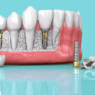 og-dental-implants